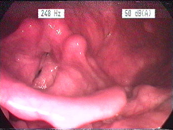 English: endoscopic documentation of larynx wi...
