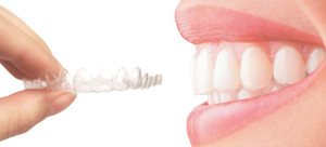 Nevidni zobni aparat ima številne prednosti